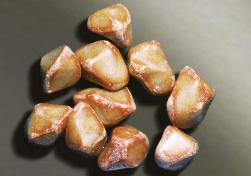 胆固醇,胆固醇结石