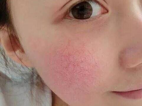红血丝去除,红血丝原因