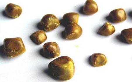 结石治疗,结石患者