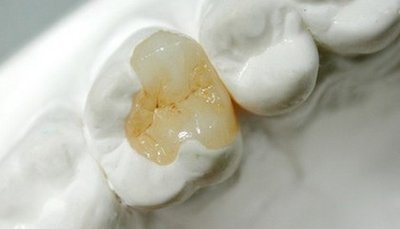 补牙,牙齿
